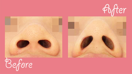 One day nose job before and after