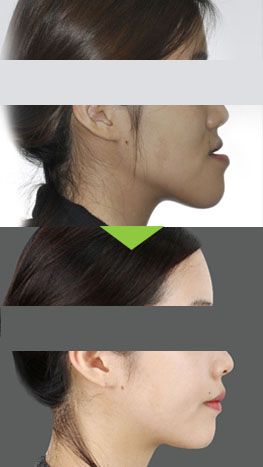 Orthognatic surgery before and after photos