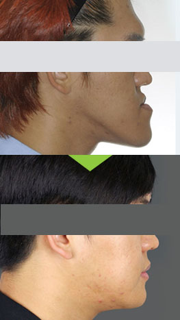 bimaxillary surgery before and after photos