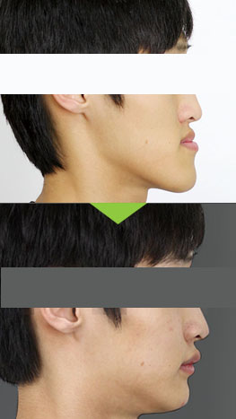 lentern jaw susrgery before and after