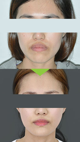 Protruding mouth before and after photos