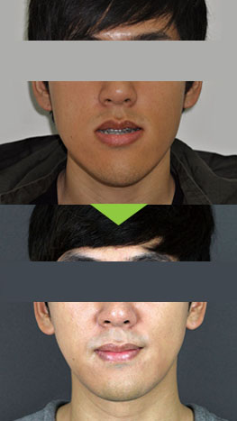 Asymmetrical face surgery before and after