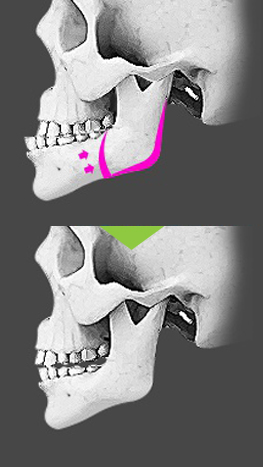 jaw surgery korea