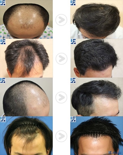 before and after photo JP plastic surgery hair transplantation