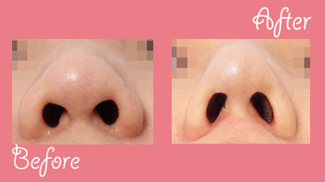 Non incision nose surgery before and after photo