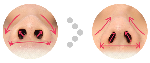 How to fix flat, wide nose in one day