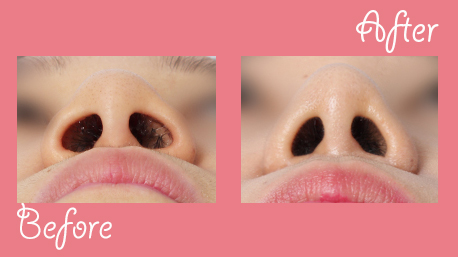 k-pop star nose before and after